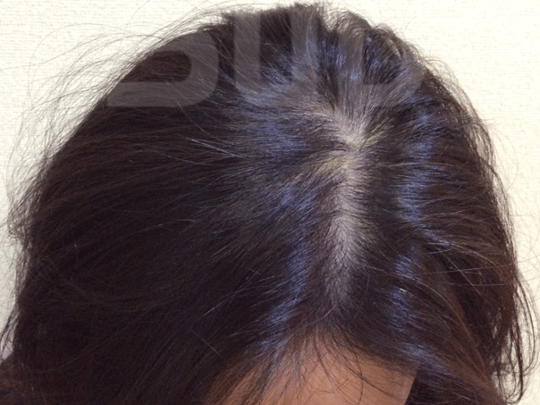 出産後の抜け毛