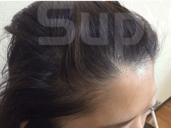 ひこう性脱毛症