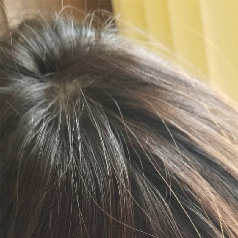 薄毛治療頭頂部