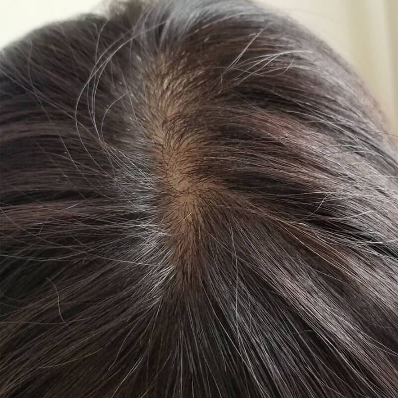 薄毛治療頭頂部