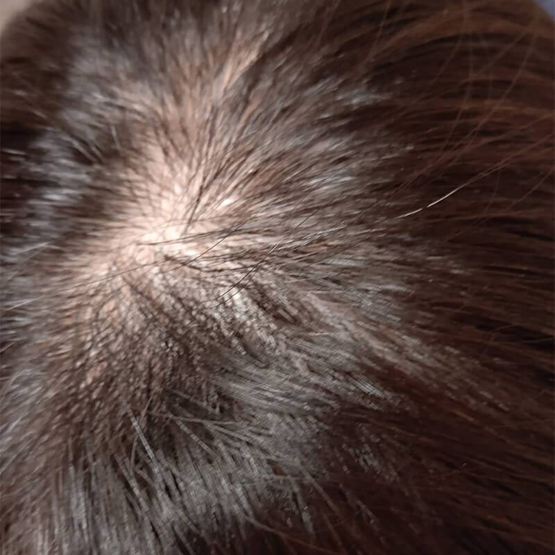 女性薄毛治療頭頂部