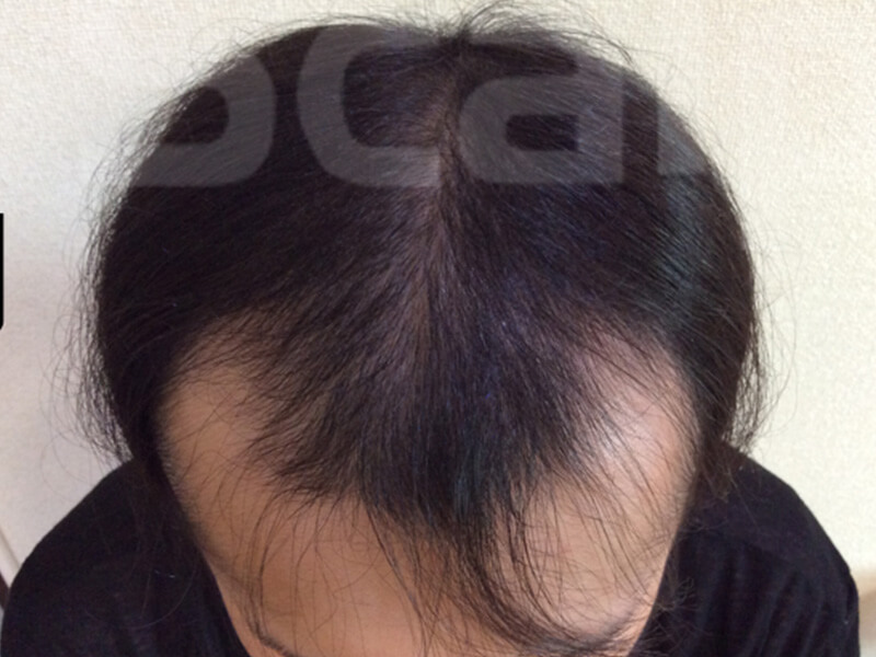 芦屋M字ハゲ