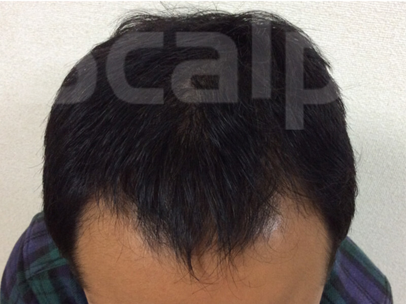 芦屋薄毛施術後