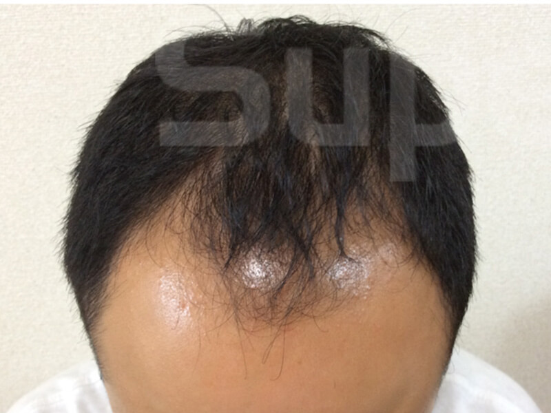 芦屋薄毛施術前後