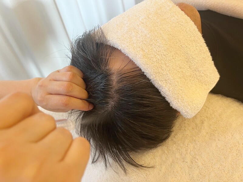 頭皮の洗浄